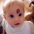 Hemangioma.jpg